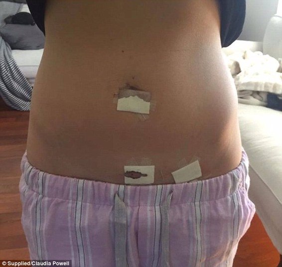 Para amenizar os sintomas da doença, Claudia precisa beber até três litros de água por dia. Se não o fizer, sente fortes náuseas e fraqueza. — Meu dia se resume a ficar na cama. Quando
acordo, minha frequência cardíaca normalmente está perto de 150 BPM (batimentos
por minuto), e pode chegar a um valor bem maior com o passar do dia. Só posso
ir ao banheiro ou à cozinha, e mesmo assim, às
vezes preciso engatinhar para chegar até os cômodos 