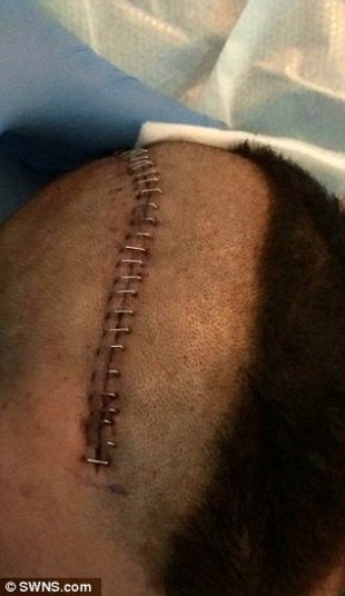 Ele foi imediatamente levado ao hospital, onde os cirurgiões removeram parte de seu crânio, com o objetivo de parar o inchaço — que já estava esmagando seu cérebro