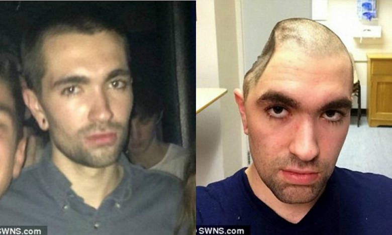 Um maratonista que sofreu um AVC (acidente vascular cerebral) enquanto corria teve uma parte de seu crânio removida em decorrência do incidente