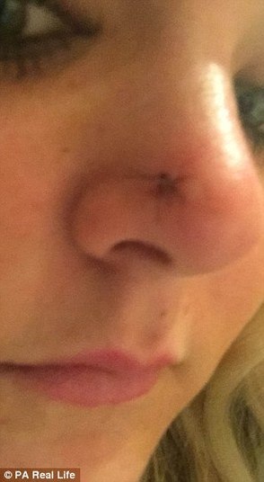 Depois de 11 anos seguindo essa rotina, em 2014 ela notou uma mancha clara se formando em seu nariz
