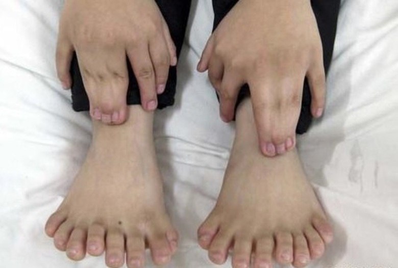 Hong Hong e a mãe têm uma condição congênita chamada polidactilia, uma anomalia causada porque uma formação alternativa do gene (alelo) é dominante nessa situaçãoEspecialistas em genética e neurologia se reúnem para buscar tratamento para NPC