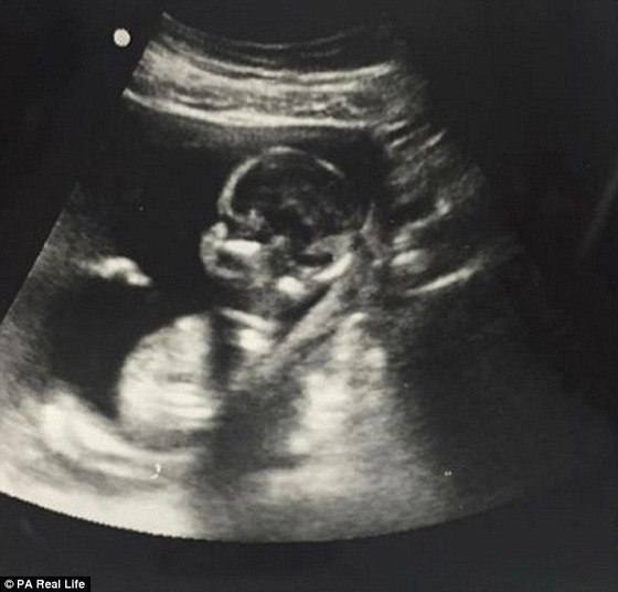 Apesar de exames
regulares terem sido realizados durante toda a gravidez, o câncer de olho não
foi identificado em Everett. Ele foi descoberto quando o bebê tinha 16 dias de
vida, no hospital de olhos Willy Eye, na Filadélfia. Os médicos confirmaram
as suspeitas de que a doença teria se desenvolvido ainda no útero da mãe. 

—
Com duas semanas de idade, Everett passou pelo seu primeiro exame de
vista. Foi quando recebemos a notícia de que ele tinha tumores em ambos os olhos. No dia
seguinte, ele começou a quimioterapia
