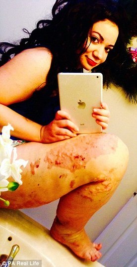 Outros
efeitos secundários incluem o desenvolvimento de varizes e o aumento do tecido adiposo que se espalha por todo o corpo. No entanto, os médicos afirmaram que o maior problema no caso de Arianna é que a doença está restrita à parte inferior do corpo. Segundo os especialistas, não se sabe o motivo pelo qual a doença não se desenvolveu na parte de cima do corpo da jovem