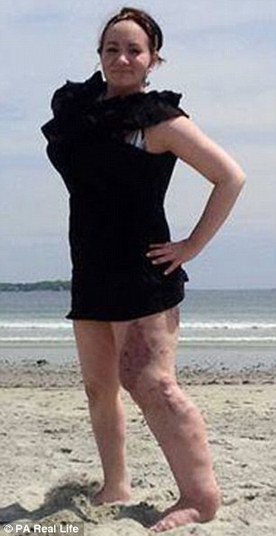 Os médicos afirmaram que a causa da doença não é genética, e que eles não desistiram de encontrar uma cura. A jovem é frequentemente atingida por infecções bacterianas repentinas, isso porque a síndrome é tão incomum e tão desconhecida, que não é possível prever desdobramentos.— Eu fiquei à beira da morte por 20 vezes