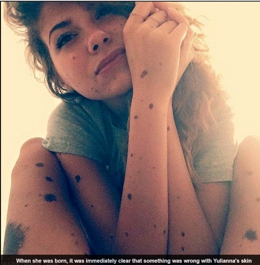 Hoje, a jovem conta que se tornou uma espécie de embaixadora de da condição nevo melanocítico congênito.— Eu estou tentando mostrar as pessoas que podemos viver uma vida normal, e não é nenhuma necessidade de esconder das outras pessoas. Eu nasci diferente, nós todos somos diferentes