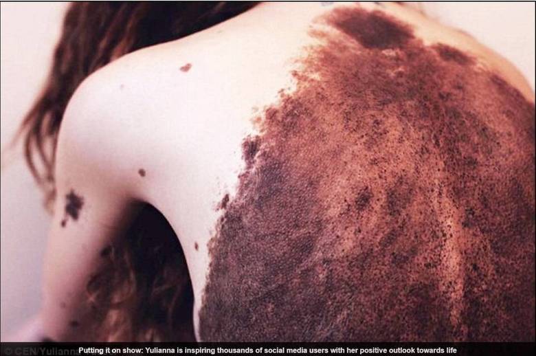 De acordo com o Daily Mail, apesar de ter sofrido bullying em sua infância, Yulianna aprendeu a lidar com seu corpo e hoje posta fotos diárias com a hashtag #bareyourbirthmark