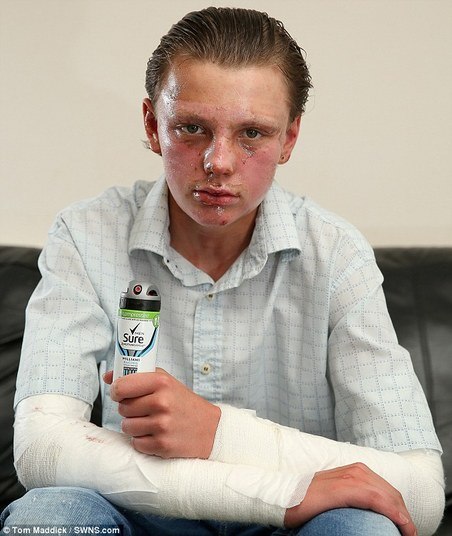 Um estudante de 14 anos de idade sofreu diversas queimaduras depois que um desodorante aerosol explodiu em seu rosto. O incidente ocorreu em Nottingham, no Reino Unido, nesta terça-feira (26)
