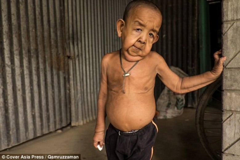 
O pai trabalha e
ganha cerca de R$ 200 por mês. Só que já gastou mais de R$ 12 mil com o filho,
tentando levá-lo para se consultar com médicos de vários lugares diferentes. 


— Estivemos em
hospitais, santuários, faquires, tudo. No entanto, sua situação continua a
mesma e ele provavelmente está ficando pior a cada dia. Meu filho não é um bebê
normal e é trágico para qualquer pai saber que seu filho não vai sobreviver por
muito tempo.
 

Debashis Bishwas, um
consultor do Hospital Central Magura, em Magura, reuniu-se com Bayezid no mês
passado e disse a seus pais que ele acredita que ele está sofrendo de progeria
e cutis laxa. O especialista analisou que o menino só vai poder viver até os 15
anos de idade.


O pai lamenta não
poder fazer nada para salvar seu filho, devido à sua condição financeira.

 

— É tão doloroso ver
que o nosso primeiro filho sofrendo de uma doença que não pode sequer ser
tratada. Como todos os pais, gostaríamos de ver nosso menino saudável. Mas
agora, sabemos que só um milagre vai nos salvar

 