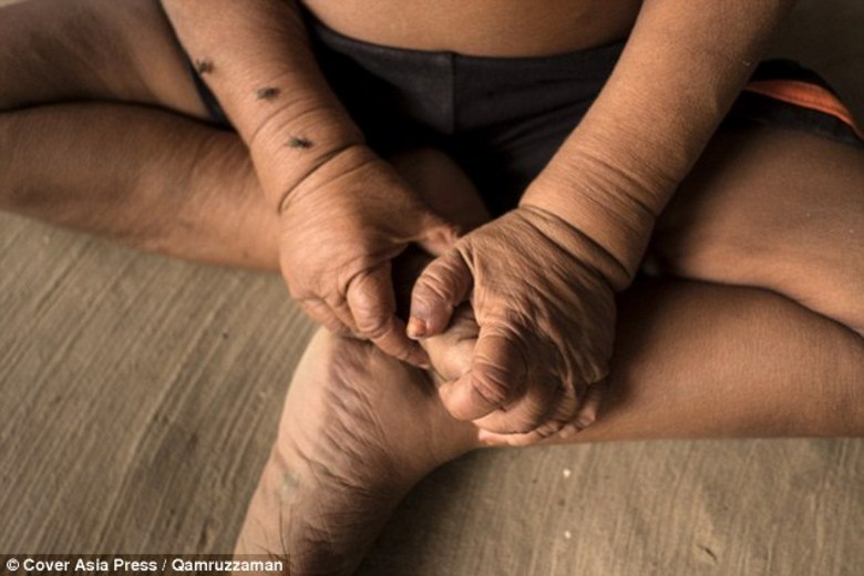— Eu fiquei apavorada
quando olhei para ele. Era apenas pele e osso, foi tão doloroso para mim. Os
médicos não tinham ideia do que fazer.

Quando voltaram para
casa, a vizinhança rapidamente descobriu que havia algo de diferente com o
filho do casal. No entanto, ninguém ofereceu apoio à família. As pessoas têm
medo de ficar perto de Bayezid, e muitos ainda especulavam sobre ele ter
nascido assim porque os pais são primos de primeiro grau. 


O menino não
frequenta a escola porque os alunos se assustam quando o veem. No entanto, sua

Inteligência é muito
superior à das crianças da sua idade. Manifesta sua criatividade com desenhos
em papel, e até mesmo quebrando seus próprios brinquedos para poder
consertá-los