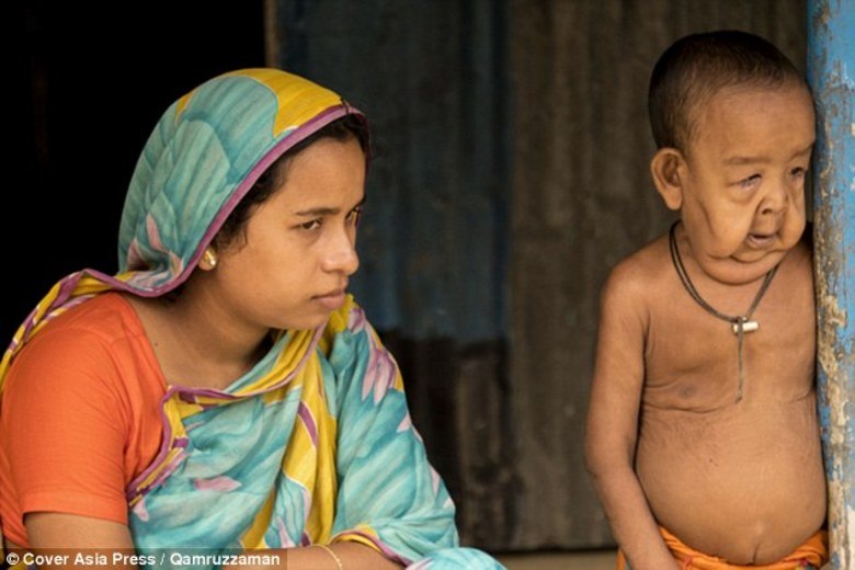 Vítimas de progeria normalmente
morrem por volta dos 13 anos, por ataques cardíacos os acidentes vasculares
cerebrais. Bayezid tem também outra condição, que faz com que a pele fique flácida
nas dobras, chamada de cutis laxa. A mãe. Tripti Khatun, de 18 anos, diz que se surpreende todos os
dias em relação à inteligência do filho.

— Seu crescimento
físico é completamente anormal, mas mentalmente, ele tem conversa maravilhosa, é
muito consciente e é muito intuitivo para sua idade.

Quando Bayezid nasceu em
uma maternidade do governo, em 2012, Tripti e seu marido Lovelu Hossain, de 22
anos, ficaram arrasados quando os médicos disseram que não sabiam como tratá-lo