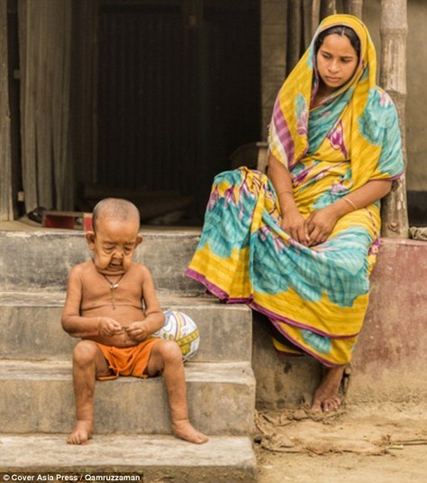 A mãe do menino contou que as pessoas da comunidade onde eles moram
ficam longe de sua família, e que as crianças têm medo de brincar com ele,
apesar de Bayezid ter uma inteligência acima da média. Médicos acreditam que a
condição rara que afeta a criança é a progeria, uma doença que faz crianças
envelhecerem rapidamente. O distúrbio inspirou o filme O Curioso Caso de
Benjamin Button, de Scott Fitzgerald