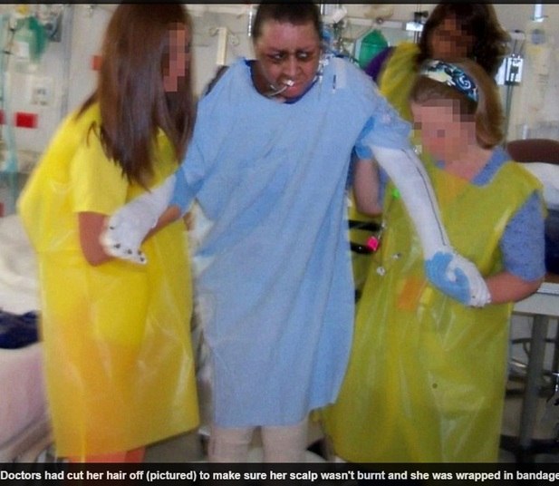 A menina se queimou por causa de uma brincadeira
perigosa com álcool