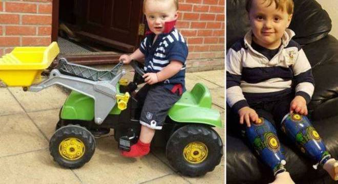 Reuben, antes e depois de pernas prostéticas