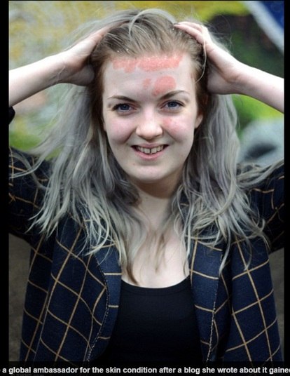 
De acordo com o site DailyMail, a jovem foi diagnosticada
com a doença há quase três anos. Ela revela que já sofreu muito com provocações
cruéis de pessoas estranhas. 

A psoríase atinge cerca de 2% da população.  No caso de Judith, as manchas aparecem na
testa, couro cabeludo e rosto. 