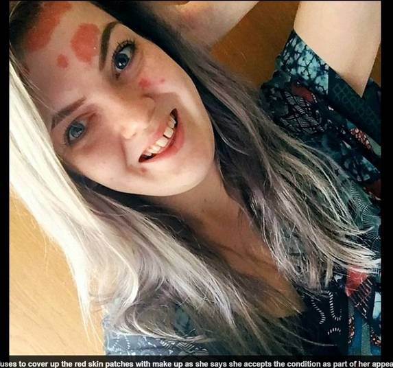 — Eu trabalhava em uma loja de roupas. Estava um dia atendendo
uma senhora e ela não parava de olhar pra minha testa. Daí ela me disse “pensei
que a pessoa tivesse que ser bonita para trabalhar aqui”. Fiquei com muito medo.
Então, tinha duas escolhas: ou deixa os comentários me destruírem ou eu não me
deixava afetar.