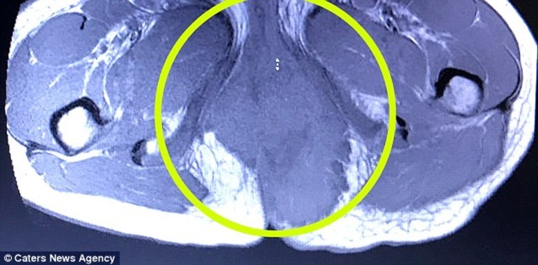 No entanto, o caroço continuou a crescer até que ele era do
tamanho de um melão. Foi em uma cirurgia com o intuito de remover um abcesso
períneo que os médicos descobriram uma grande massa em suas nádegas. 

Ao passar por uma tomografia computadorizada, chegaram ao real
diagnóstico: rabdomiossarcoma alveolar — uma forma de câncer de tecidos moles. A jovem passou por seis meses de radioterapia para tratar a doença. Agora, o
tumor desapareceu completamente e Elie está 90% recuperada