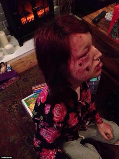 A agressão também ficou marcada de outra maneira: a emocional. E somente agora ela começa a se recuperar do estresse pós-traumático e da crise de ansiedade:— Quando eu vi meu reflexo no espelho eu não queria me reconhecer. Pensei que Jamie falou certo, ninguém nunca iria olhar para mim novamente. Eu parecia um monstro