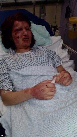 Ele cometeu a agressão selvagem na pessoa a quem um dia disse amar. Um olho completamente inchado, a maçã do rosto fraturada, lacerações pelo corpo e a face mordida foram o resultado:— Jamie mordeu o meu rosto 21 vezes (ela se recorda da intensidade). Senti que estava tentado me devorar viva