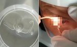 Um paciente teve cerca de 20 vermes removidos ainda vivos de um dos olhos, no Hospital Municipal de Suzhou, na China. ATENÇÃO: IMAGENS FORTES A SEGUIR!
