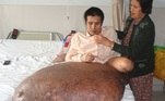 Um vietnamita com tumor de 90 kg na perna foi operado para tentar readquirir a normalidade perdida há quatro anos em uma cirurgia com 50% de possibilidades de sucesso