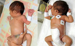 O bebê que nasceu com seis pernas em Sindh, no Paquistão, foi operado com sucesso em 19 de abril de 2012. A cirurgia foi feita no Instituto Paquistanês de Saúde Infantil, em Karachi