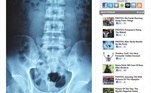 Um homem de Guangzhou, na China, passou por uma cirurgia depois de inserir uma agulha de acupuntura no pênis enquanto assistia a um vídeo pornô