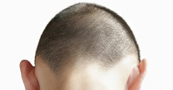 Queda De Cabelo Caspa E Piolho Conheca Os Tratamentos E Outros