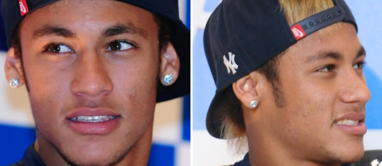 Neymar luta contra as acnes no rosto