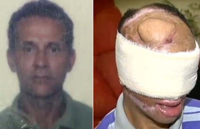 Há três anos, o garimpeiro Domingo, de Manaus (AM), perdeu o rosto por causa de uma grave queimadura provocada por um raio. Por conta disso, ele pede ajuda para reconstruir o rosto. Leia mais
