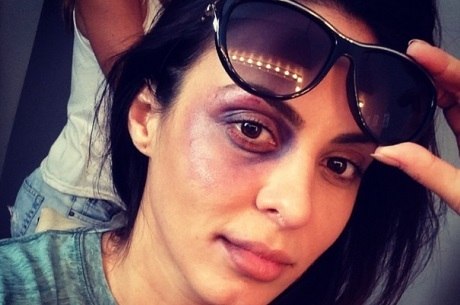 Alinne Rosa explica "hematomas" no olho e na boca no Instagram