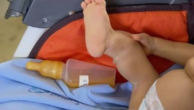A osteogênese imperfeita, também chamada de ossos de vidro, é uma doença genética e hereditária que afeta cerca de 12 mil pessoas em todo o paÃs, de acordo com a Associação Brasileira de Osteogênese Imperfeita (ABOI). A estimativa é que uma criança a cada 20 mil nascidas tenham ossos de vidro. O que causa o problema é a incapacidade do organismo de produzir ou sintetizar o colágeno tipo 1, que tem a função de dar força e sustentação aos ossos - sem essa proteÃna, eles quebram com muita facilidade. Ao longo da vida, um paciente pode ter dezenas ou até centenas de fraturas e isso pode causar sequelas irreversÃveis como o encurvamento dos ossos, principalmente de braços e pernas. Não existe um tratamento especÃfico para esta doença, mas alguns medicamentos podem dar mais força para os ossos a partir do cálcio que se encontra na circulação. Um programa do governo federal garante acesso a esses remédios por meio do Sistema Ãnico de Saúde (SUS)