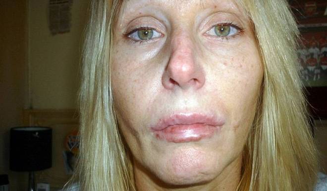 A britânica Stacey Hohn, de 41 anos de idade, ficou com o
rosto deformado após uma cirurgia de preenchimento dos lábios. O material aplicado provocou inflamação. A informação é
do site Daily Mail


