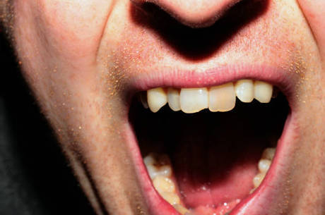 Por que alongar a mandíbula? Porque quase todos nós já cerrou os dentes