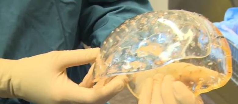 Mulher teve quase todo o seu crânio substituído por um implante criado em impressora 3D