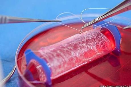 Tecido artificial foi implantando em pacientes que sofriam de má formação dos órgãos genitais Tecido artificial foi implantando em pacientes que sofriam de má formação dos órgãos genitais