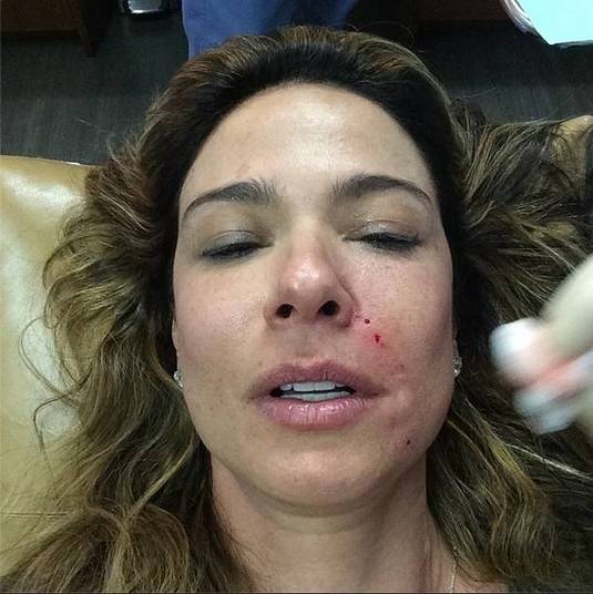 Como livrar-se de manchas pretas depois de pontos de beleza