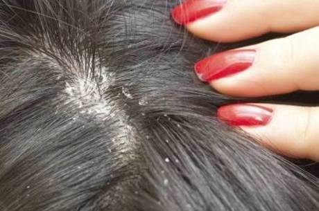 Segundo especialista, o tratamento da caspa não é curativo e apenas trata dos sintomas Segundo especialista, o tratamento da caspa não é curativo e apenas trata dos sintomas