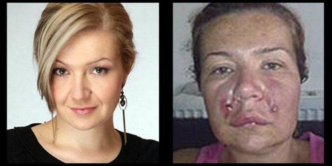 Uma apresentadora de TV da Bósnia reclama que seu rosto ficou deformado após cirurgia estética. Lejla Zvizdic, de 35 anos, afirma que a deixaram como um monstro depois de ver o resultado do procedimento realizado na capital do país, Saravejo. As informações são do site Dailymail