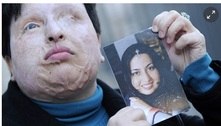 Iraniana cega e desfigurada por ataque de ácido diz que se sente culpada por ter perdoado agressor 