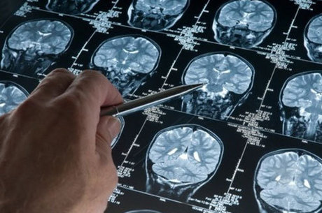 A esclerose múltipla é uma doença autoimune que atinge o sistema nervoso, causando desmielinização e inflamação