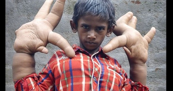 Impressionante: menino indiano com mãos gigantes muda de vida após ...