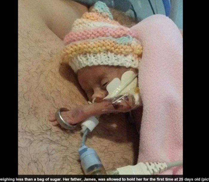 Emocionante Bebe Com 500 Gramas Luta Para Sobreviver Fotos R7 Saude