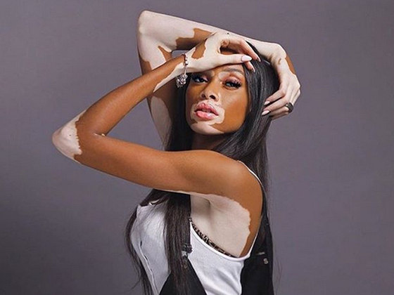 Após sofrer bullying, modelo com vitiligo quebra barreiras no mundo da moda