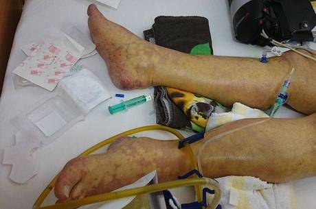 O tratamento ocorre com uso de antibiótico, soro na veia para normalizar a pressão e combater a desidratação
O tratamento ocorre com uso de antibiótico, soro na veia para normalizar a pressão e combater a desidratação