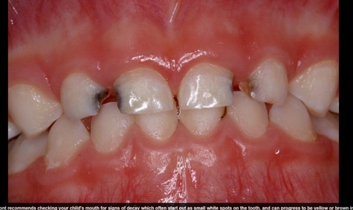 Featured image of post Dente Encavalado Feio 2 meses de tratamento
