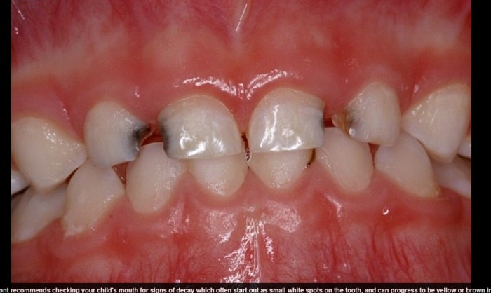 Imagens chocantes mostram como o açúcar pode destruir os dentes das