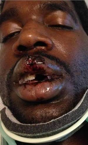 Acidente fez com que o homem ficasse com o pescoço quebrado e a boca queimada
Acidente fez com que o homem ficasse com o pescoço quebrado e a boca queimada