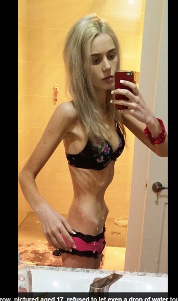 Jovem anoréxica quase morre após ficar uma semana sem comer