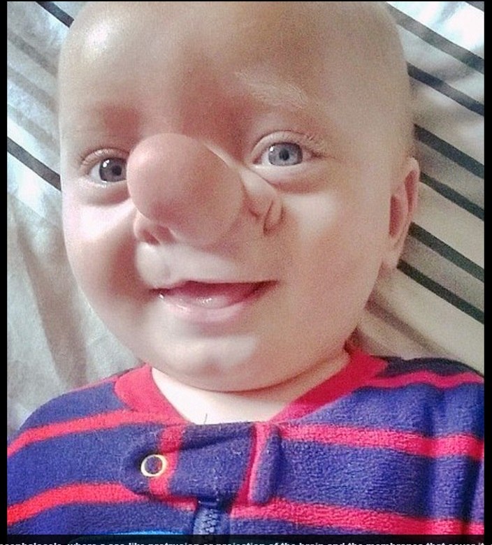 Conheça o menino que nasceu com o cérebro dentro do nariz: "É de partir o  coração", diz a mãe - Fotos - R7 Saúde