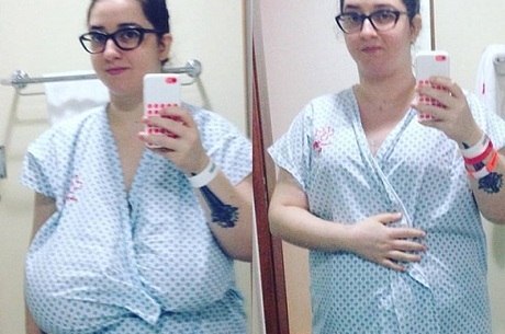 Jornalista Supera Doenca Que Faz A Mama Ficar Gigante E Retira 6 Kg De Seios Noticias R7 Brasilia